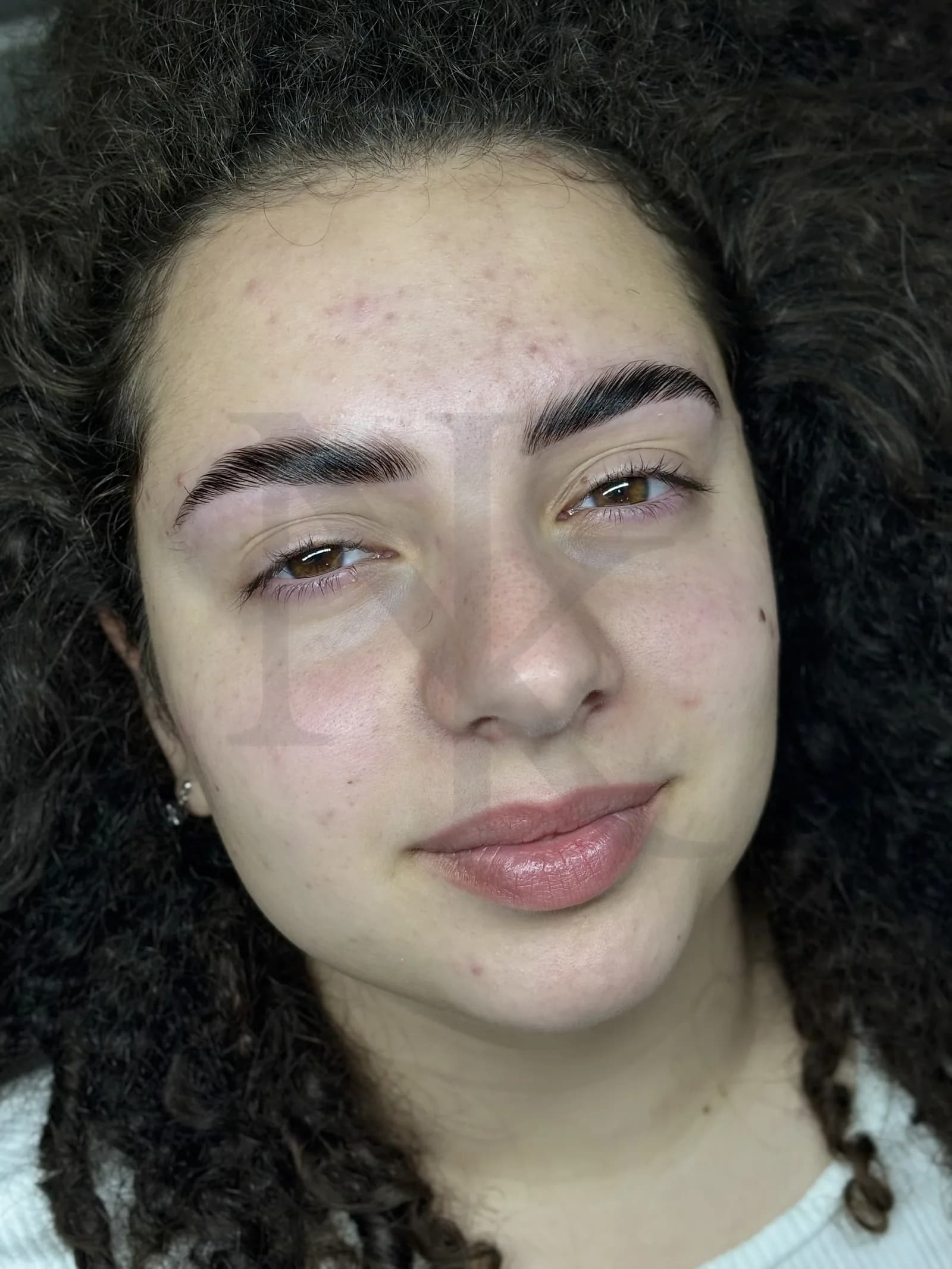 Brow lift + botox 2